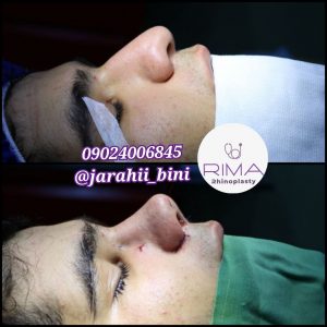 جراحی بینی گوشتی