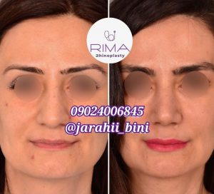 جراحی بینی گوشتی