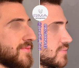 مراقبت های جراحی بینی