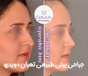 جراحی بینی طبیعی تهران
