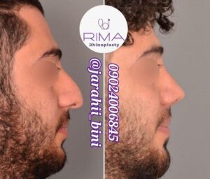 جراحی بینی طبیعی تهران