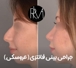 جراحی بینی فانتزی
