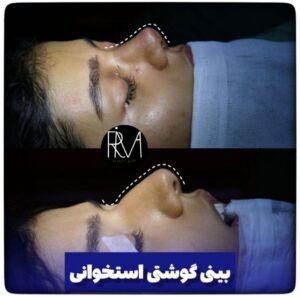 جراحی ترمیمی بینی