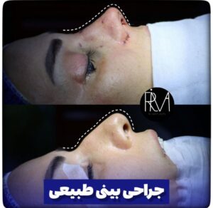 جراحی ترمیمی بینی 