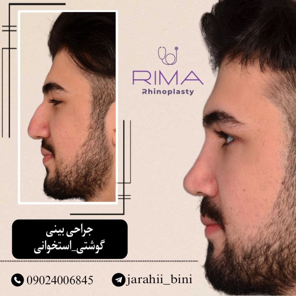 جراحی بینی نیمه فانتزی