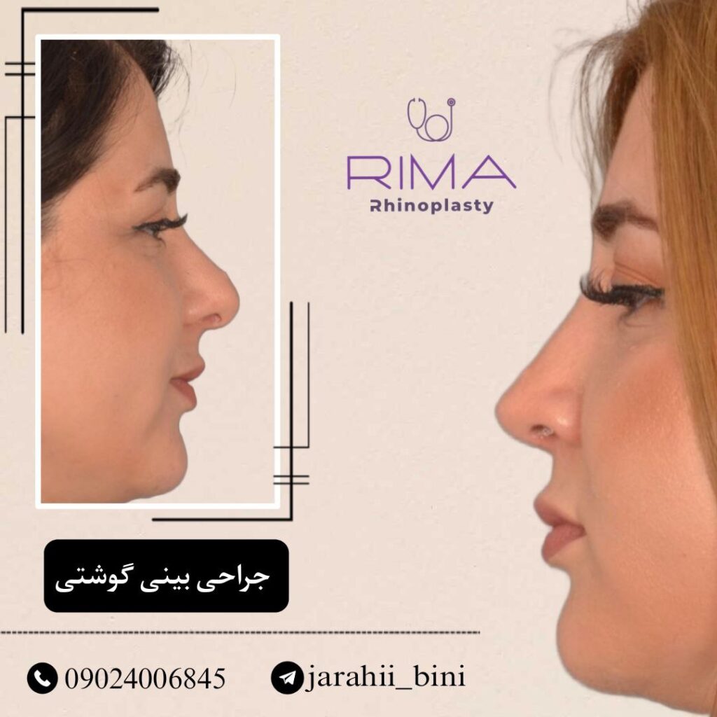جراحی بینی نیمه فانتزی 