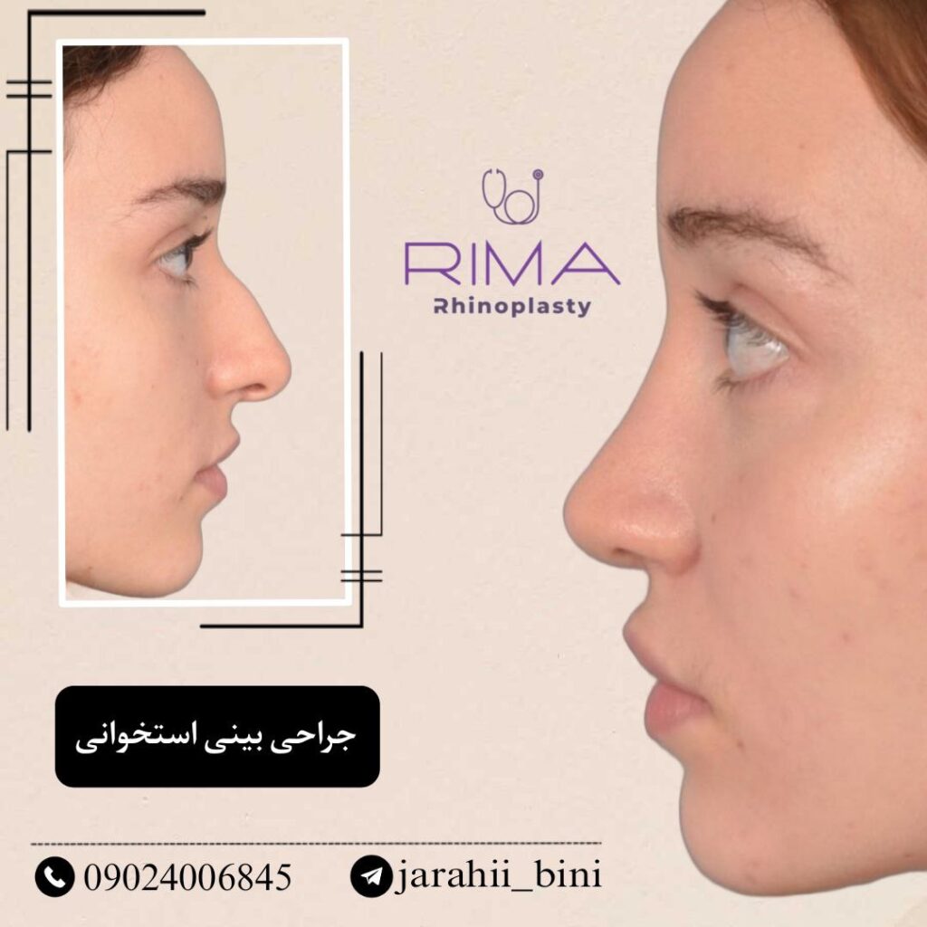 بینی نیمه فانتزی