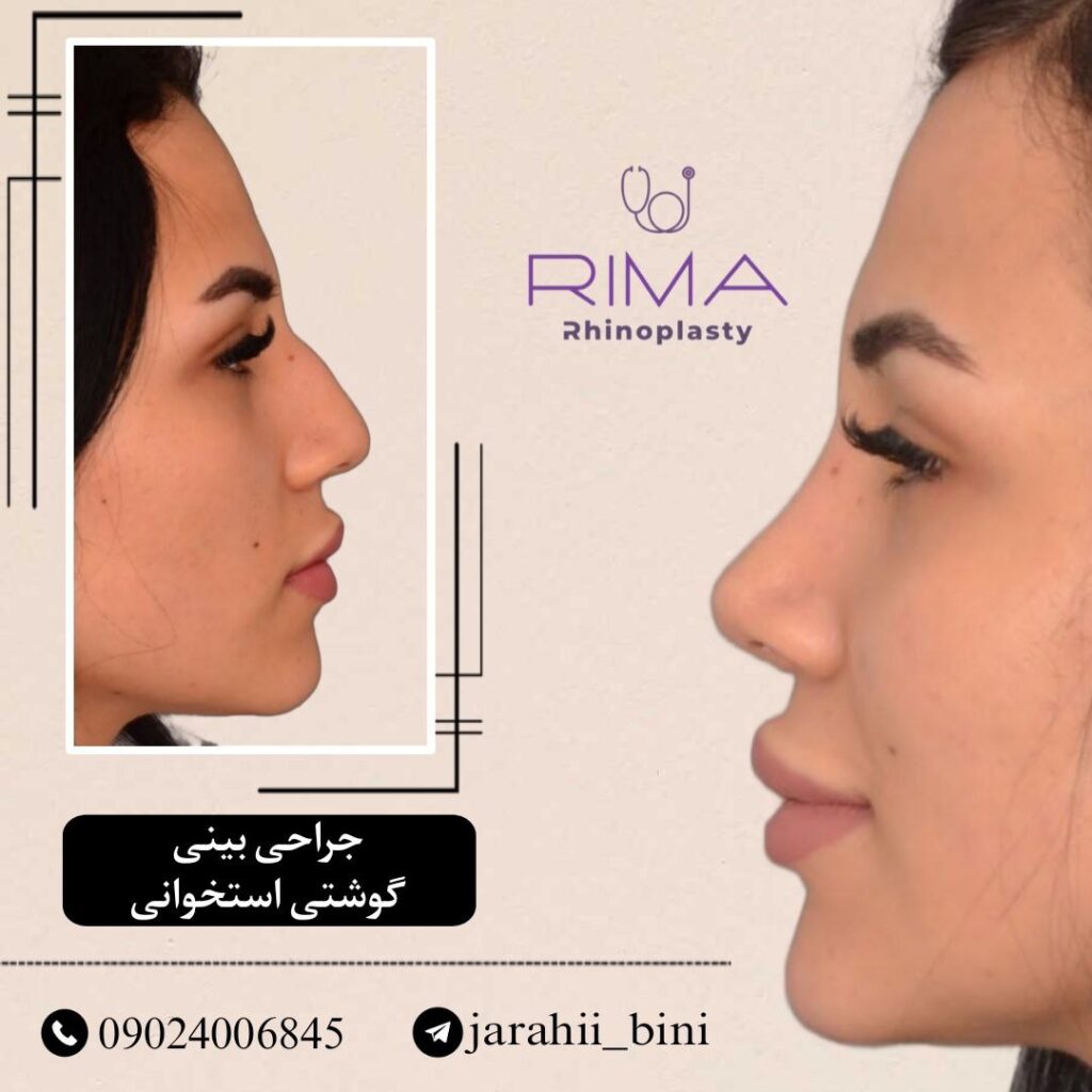 جراحی بینی نیمه فانتزی 