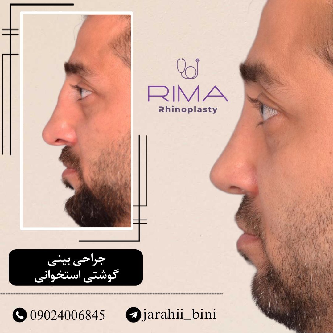 عمل بینی
