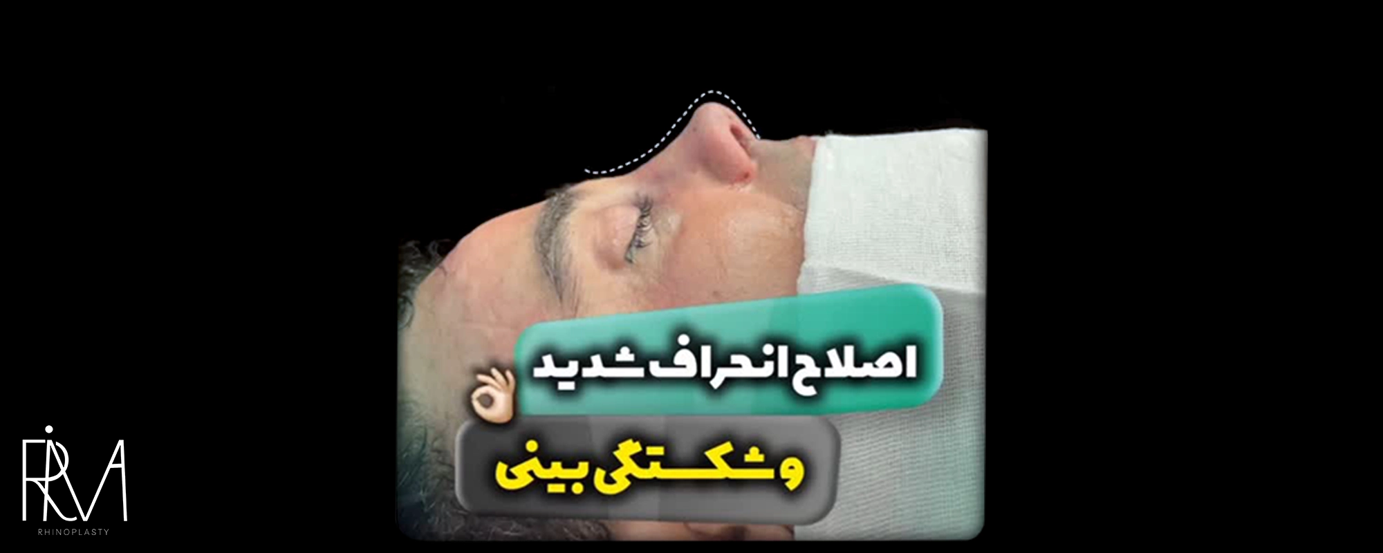نمونه جراحی بینی در ریما