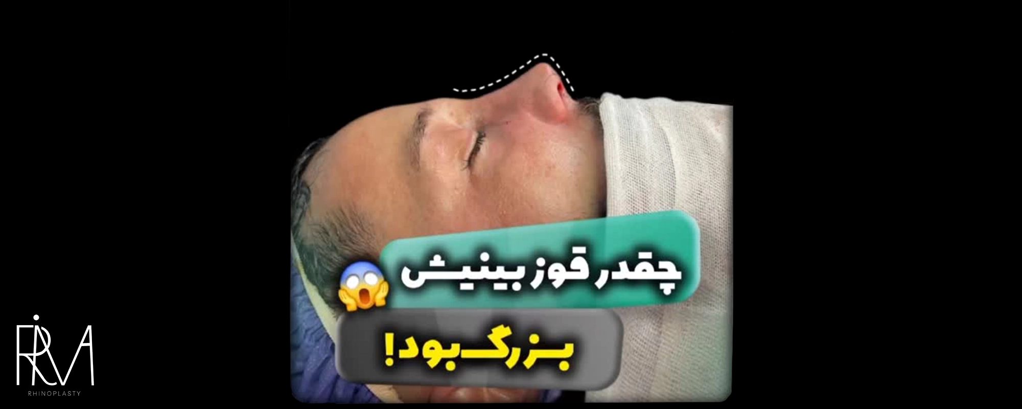 نمونه جراحی بینی در ریما