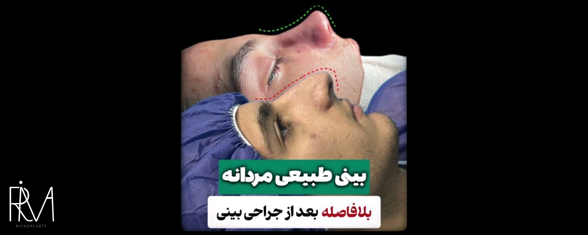 نمونه جراحی بینی در ریما
