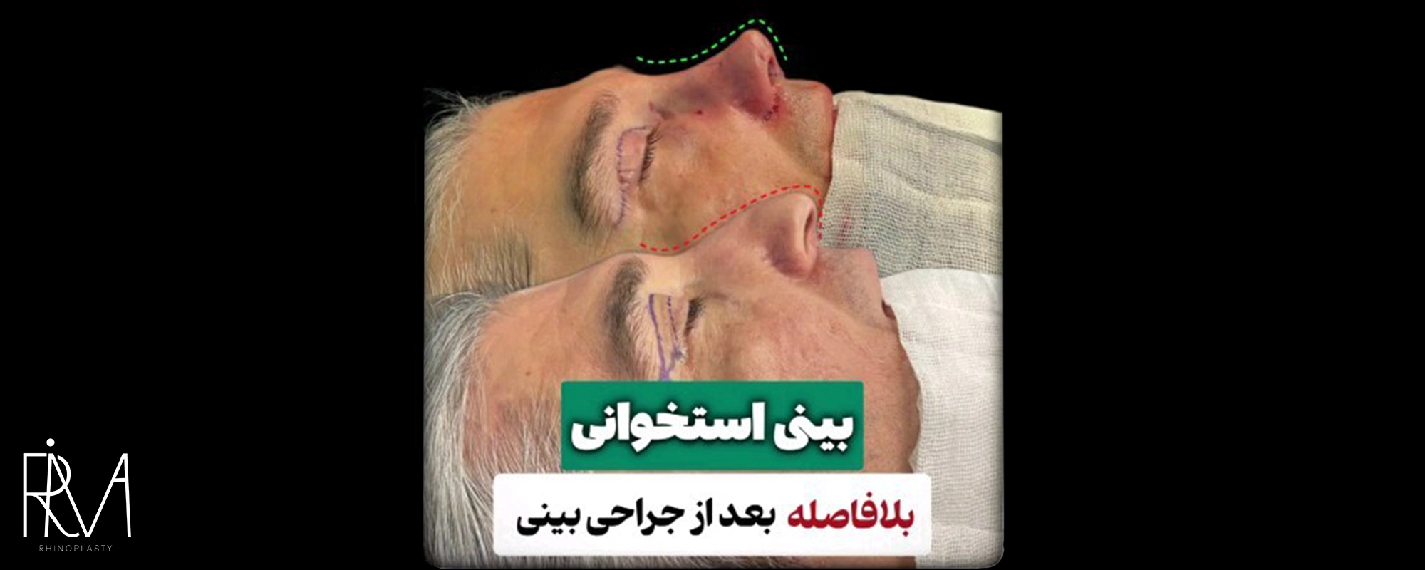 نمونهکار جراحی بلفاروپلاستی در کلینیک جراحی ریما