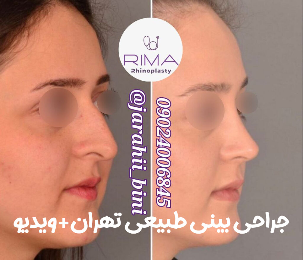 جراحی بینی طبیعی تهران