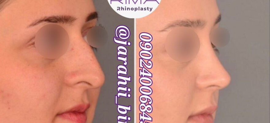 جراحی بینی طبیعی تهران