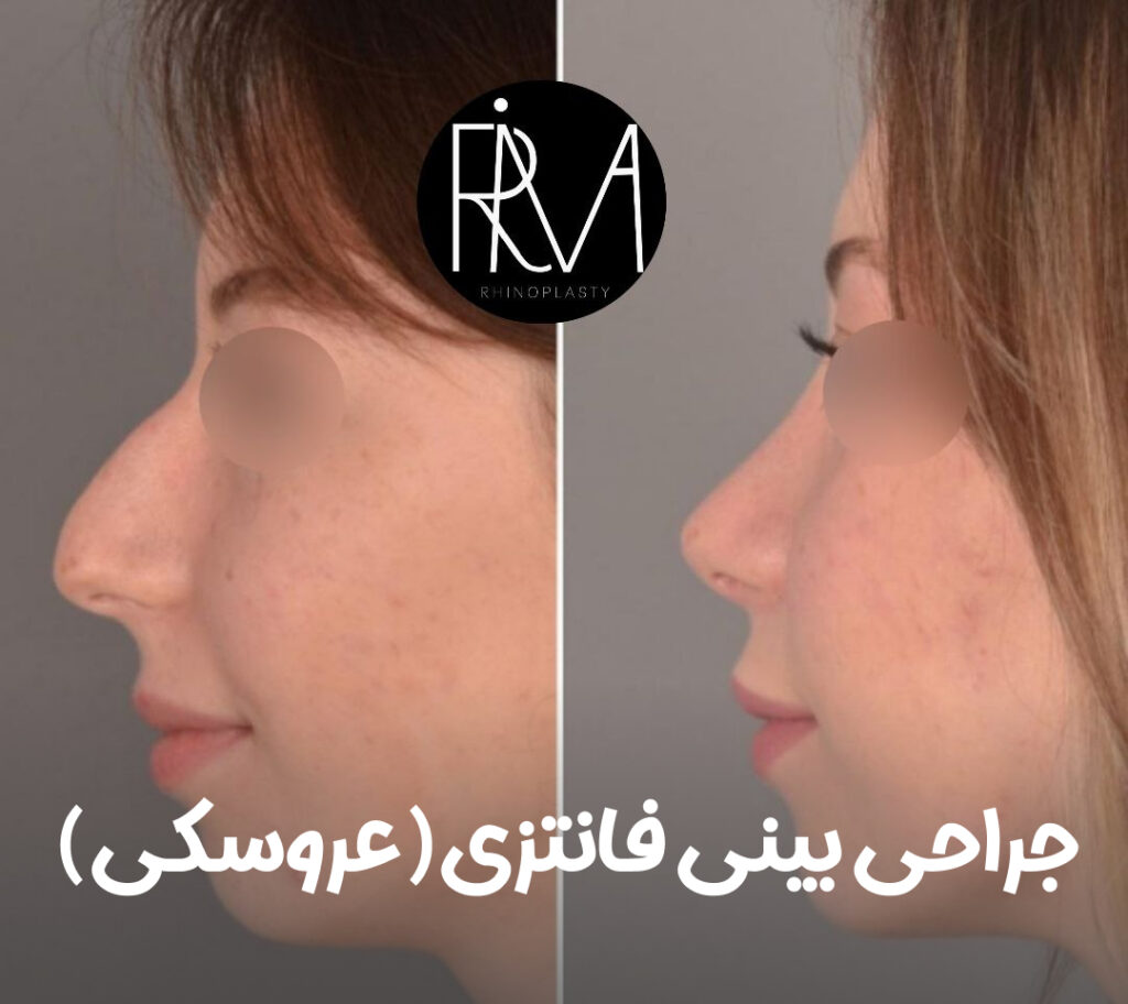 جراحی بینی فانتزی