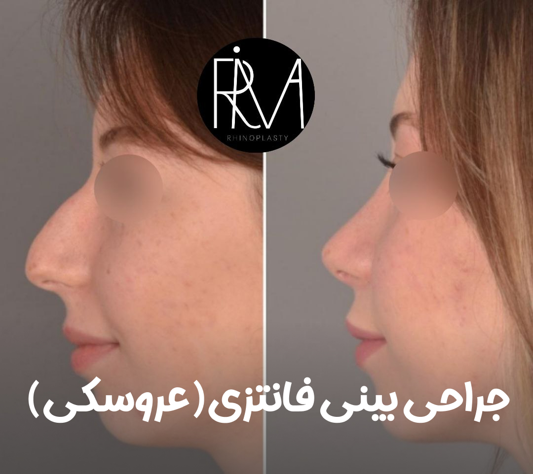 جراحی بینی فانتزی