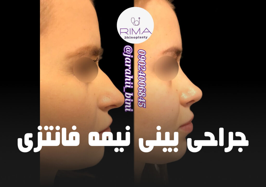 جراحی بینی نیمه فانتزی