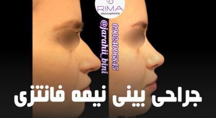 جراحی بینی نیمه فانتزی
