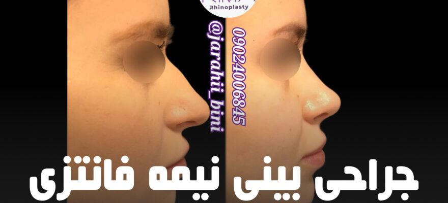 جراحی بینی نیمه فانتزی