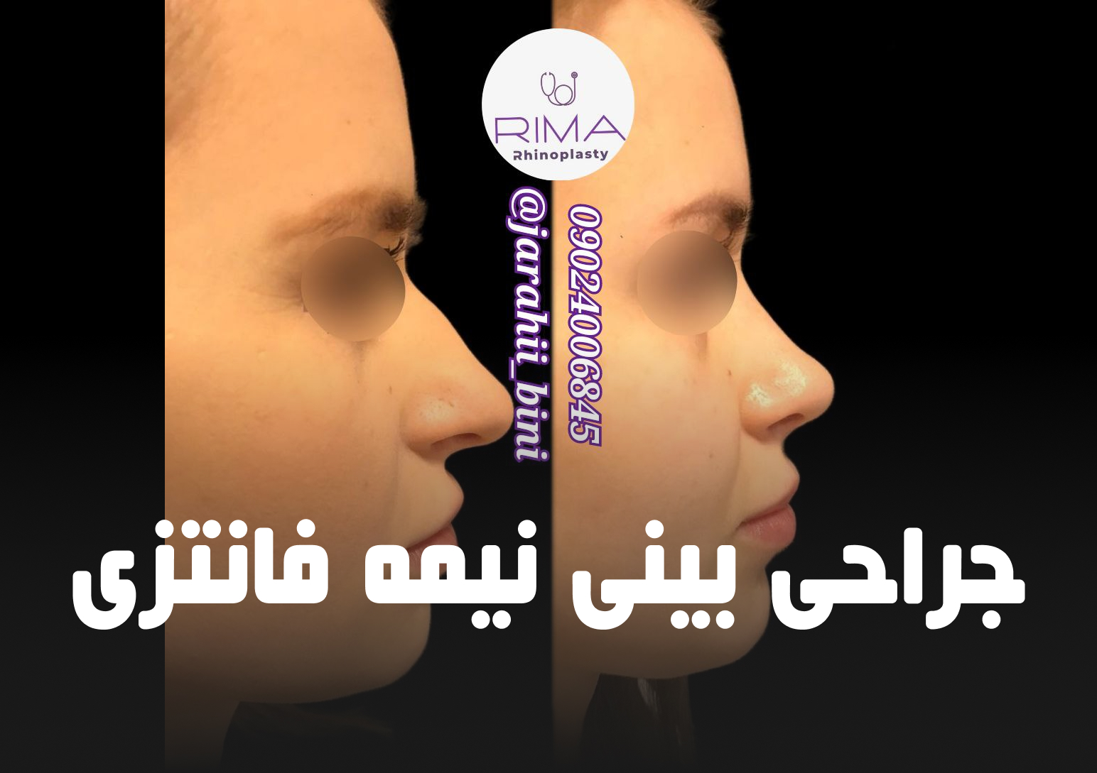 جراحی بینی نیمه فانتزی