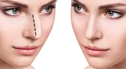انواع روش های جراحی بینی