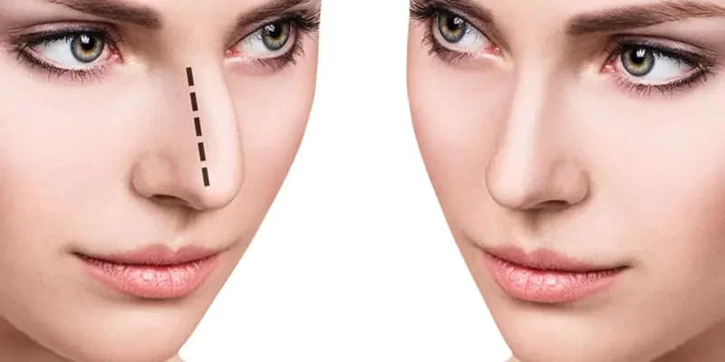 انواع روش های جراحی بینی