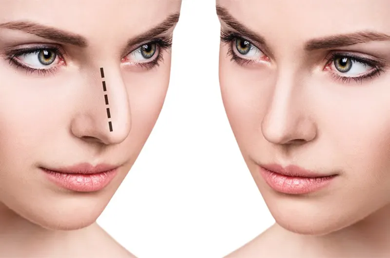 انواع روش های جراحی بینی